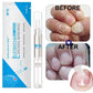 Nail Fungal Treatment Pen