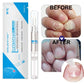 Nail Fungal Treatment Pen